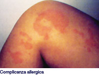 complicanza allergica